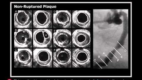 Intravascular Ultrasound