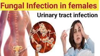 Fungal infection in urine | Fungal infection in pregnancy | yeast cells #viralvideo