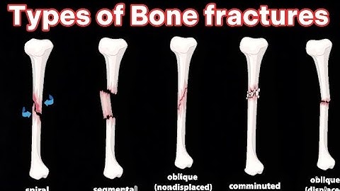 Types of bone fractures | 3D animation | Bone fractures