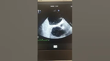 A Transesophageal Echocardiogram PFO Patent Foramen Ovale 