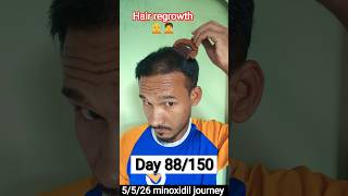 ​Day 88/150 Mintop Alcohol Free Minoxidil Journey | Real Results | 5 May #minoxidil