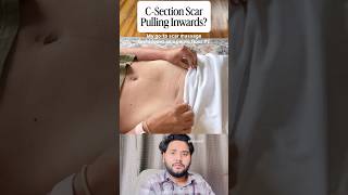 C-Section Scar Removed 🤰🏻 #viral #medical #pregnancy #shorts #surgery