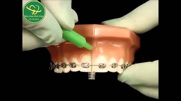 Cách vệ sinh răng miệng sau khi Niềng Răng - Nha Khoa Minh Châu