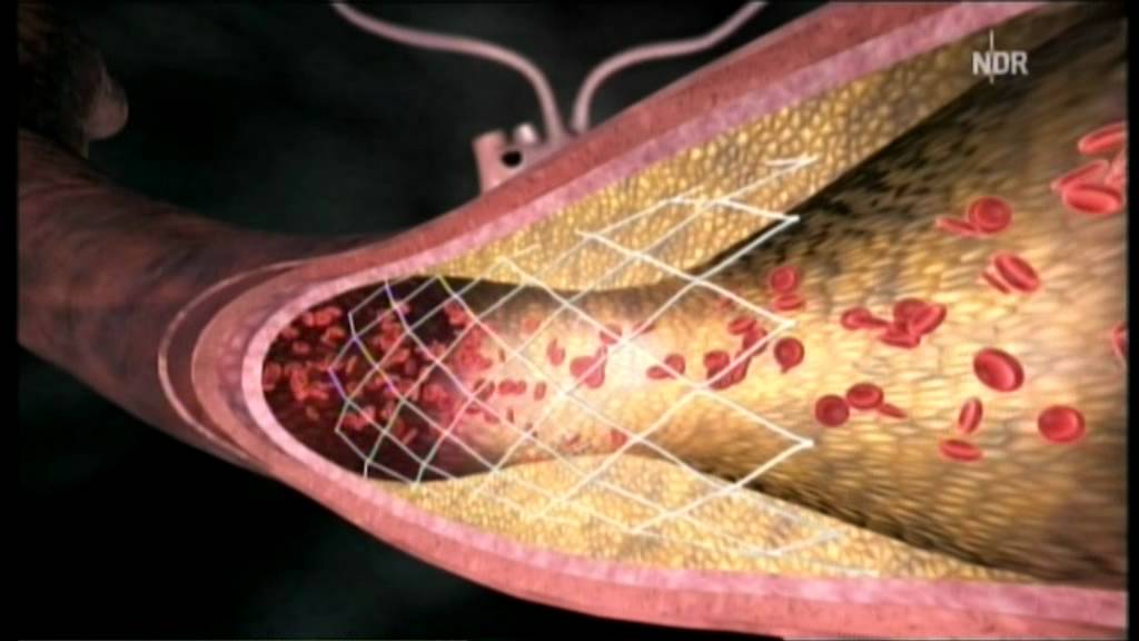 Arteriosklerose Stent oder Bypass YouTube