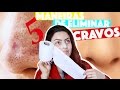 COMO REMOVER CRAVOS DO NARIZ EM 2 MINUTOS - 5 TÉCNICAS CASEIRAS | KIM ROSACUCA