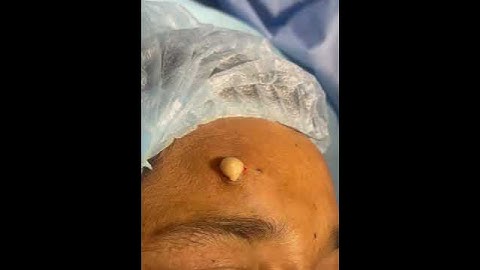 Surgical excision of sebaceous cyst #maxillofacialsurgeon #celebritysurgeon  Dr Varun Nambiar!