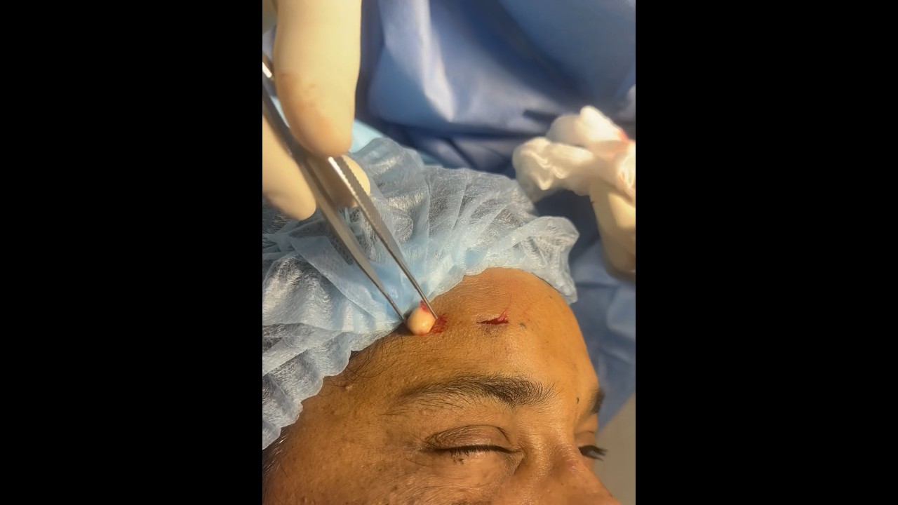 Surgical excision of sebaceous cyst #maxillofacialsurgeon #celebritysurgeon Dr Varun Nambiar!