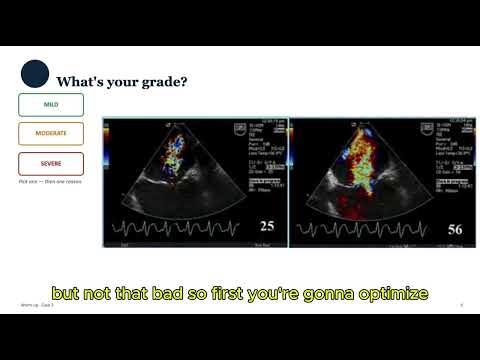 ECHO LECTURE. AORTIC REGURGITATION.