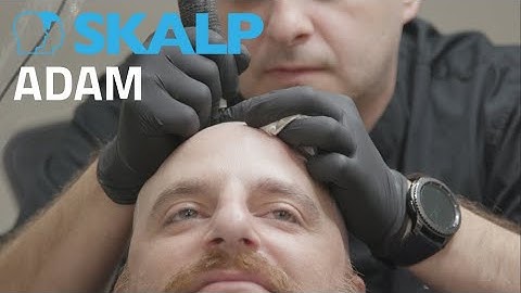 Scalp Micropigmentation by Skalp® Adam and his wife Jessica