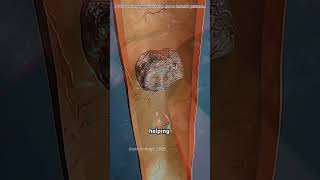 Kidney stones removal surgery #motivation #doctor #epicmusicword #3danimation
