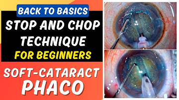 Phaco basics "Stop and chop technique in Soft Cataract" for beginners - Dr. Deepak Megur