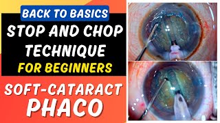 Phaco Basics Stop And Chop Technique In Soft Cataract For Beginners - Dr Deepak Megur