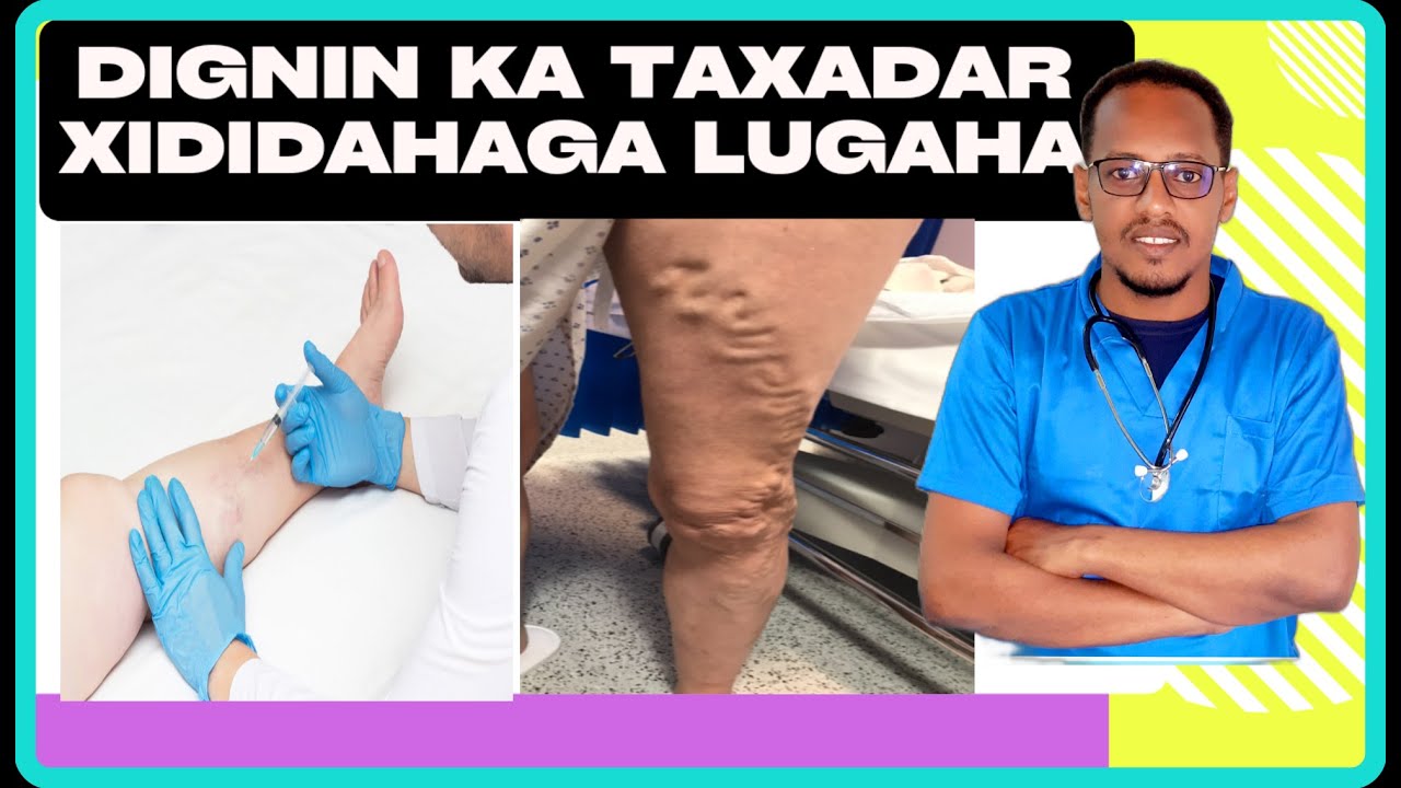 XIDADAHA LUGAHA MARKA EY XIRMAN CALAMADAHA LAGU GARTO & WAX KENA (VARICOSE VIENS) DR. MAHAMED LIBAAN