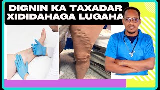 Xidadaha Lugaha Marka Ey Xirman Calamadaha Lagu Garto & Wax Kena Varicose Viens Dr. Mahamed Libaan