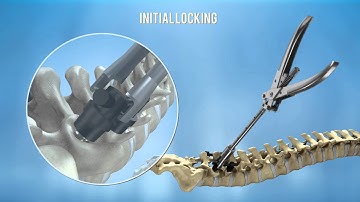 CarboClear Pedicle Screw System