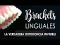 ESTO SI ES ORTODONCIA INVISIBLE: BRACKETS LINGUALES