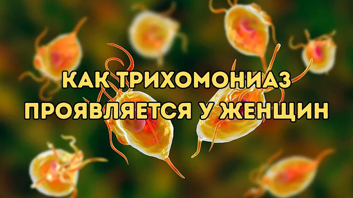 Как трихомониаз проявляется у женщин #трихомонады #инфекция #доказательнаямедицина
