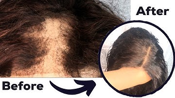 HAIR TRANSFORMATION: REFRESHING DRY OLD HAIR + FIXING A BALDING FRONTAL/CLOSURE