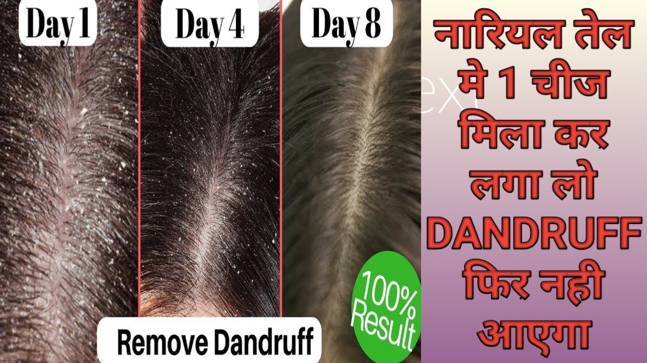 1 ही दिन मे CoConut oil se Dandruff दूर करके बालो को Lamba बनाने का