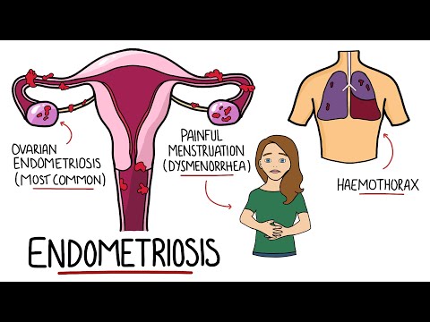 Endometriosis for Students and Junior Doctors (Signs & Symptoms, Diagnosis, Pathology, Treatment)