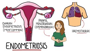 Endometriosis Explained (Signs & Symptoms, Diagnosis, Pathology, Treatment)