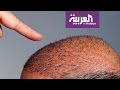 صباح العربية: تقنية جديدة لزراعة الشعر دون جراحة