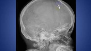 radiology round cases wormian bones
