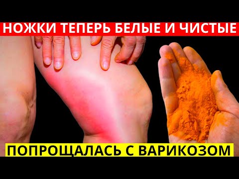 ЯДРЕНЫЙ УБИЙЦА ВАРИКОЗА! Всего 1 ЩЕПОТКА КУРКУМЫ с...И за 15 мин в день Ножки Белые и ЧИСТЫЕ!