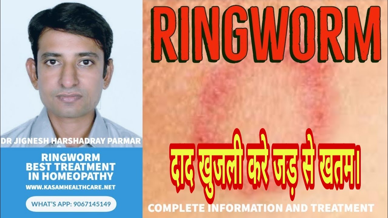RINGWORM HOMEOPATHIC TREATMENT FOR RINGWORM FULL EXPLANATION RINGWORM