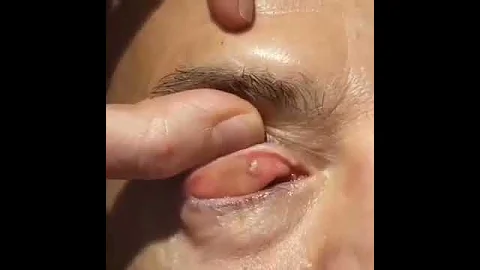 Удаление ячменя (халязиона)