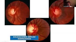 “TIPS” PARA LA EVALUACIÓN DE UNA PAPILA SOSPECHOSA DE GLAUCOMA - DR. FÉLIX GIL C.