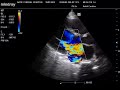 Severe Mitral Regurgitation