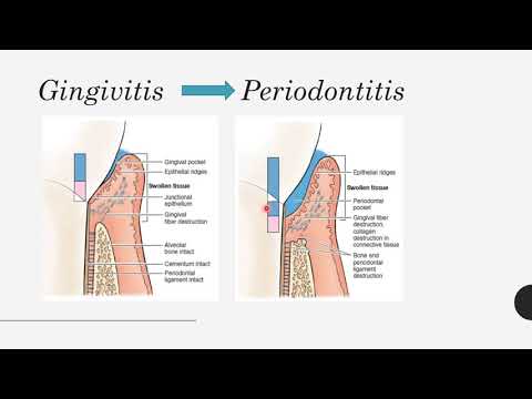 Video: Gingivitis Dan Penyakit Periodontal Pada Musang
