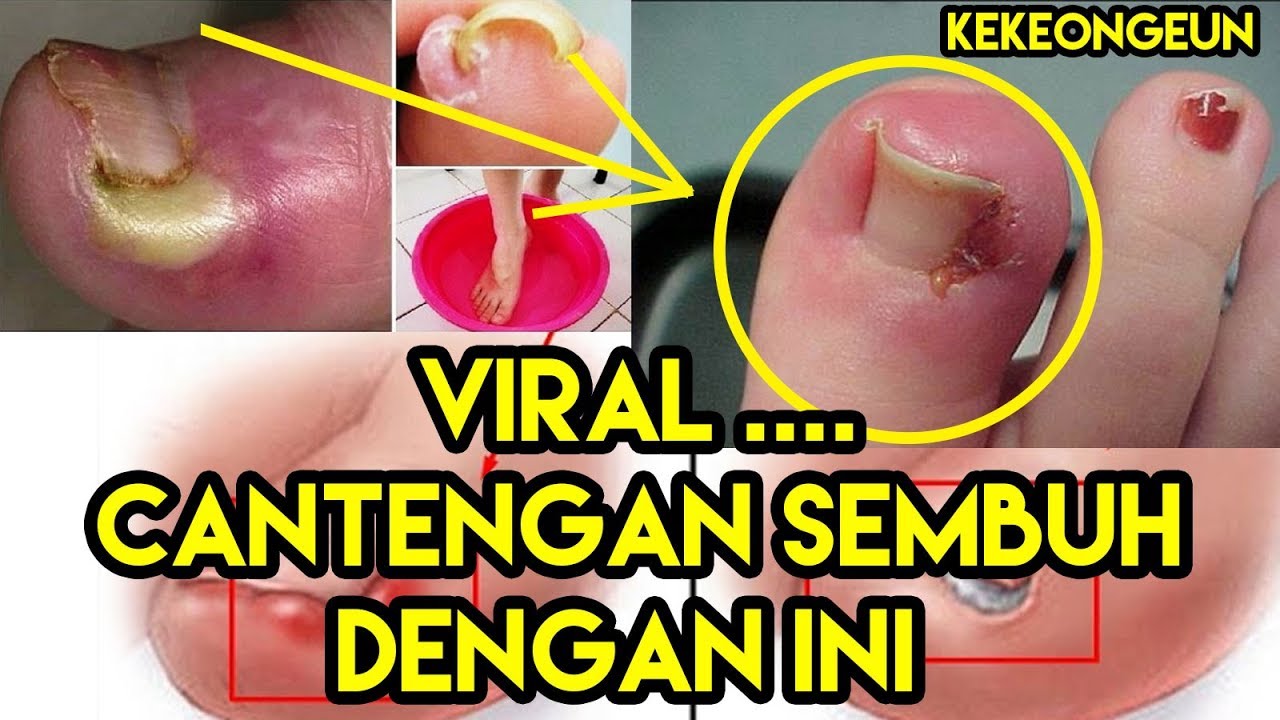 Cara Mengobati Kuku Cantengan Jempol Kaki (Kekeongeun) Paling Ampuh