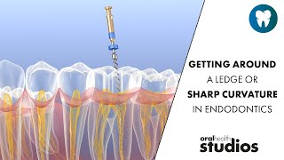 Getting around a ledge or sharp curvature in endodontics | Weekly Wisdom 🦷