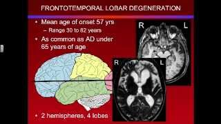 Overview of Frontotemporal Lobar Degeneration