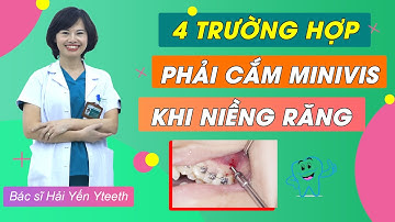 Minivis là gì? những trường hợp niềng răng nào cần phải cắm minivis || Bác sĩ Yến Yteeth