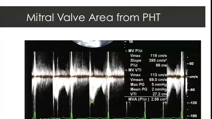 Dr Bruce Cartwright: Intraoperative Echocardiograp...