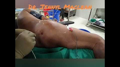 Labats classical approach to sacral plexus block