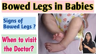 Bowed legs in babies in hindi | Bowed legs के लिए कब डॉक्टर को दिखाएं?