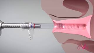 Diva L Feminine Rejuvenation At Synergy In Raleigh, Nc