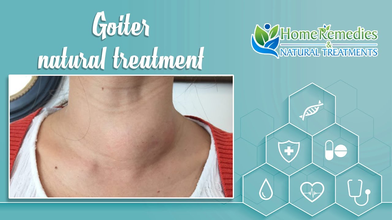 Natural Treatments And Home Remedies For Goiter Youtube