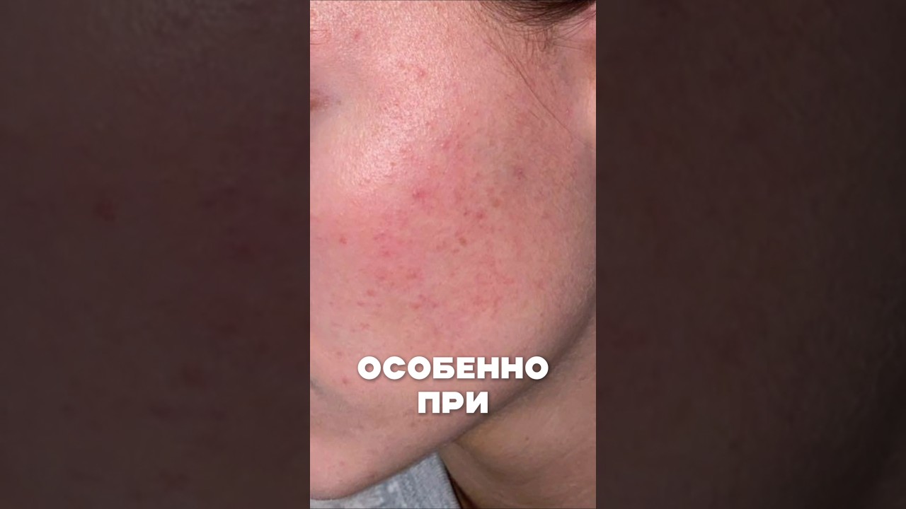 Способы лечения розацеа #shorts
