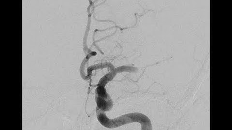 Stroke. Left M1 Occlusion. ADAPT