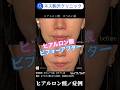 【ネス駒沢クリニック】ヒアルロン酸注射のビフォーアフター #美容 #皮膚科 #シワ
