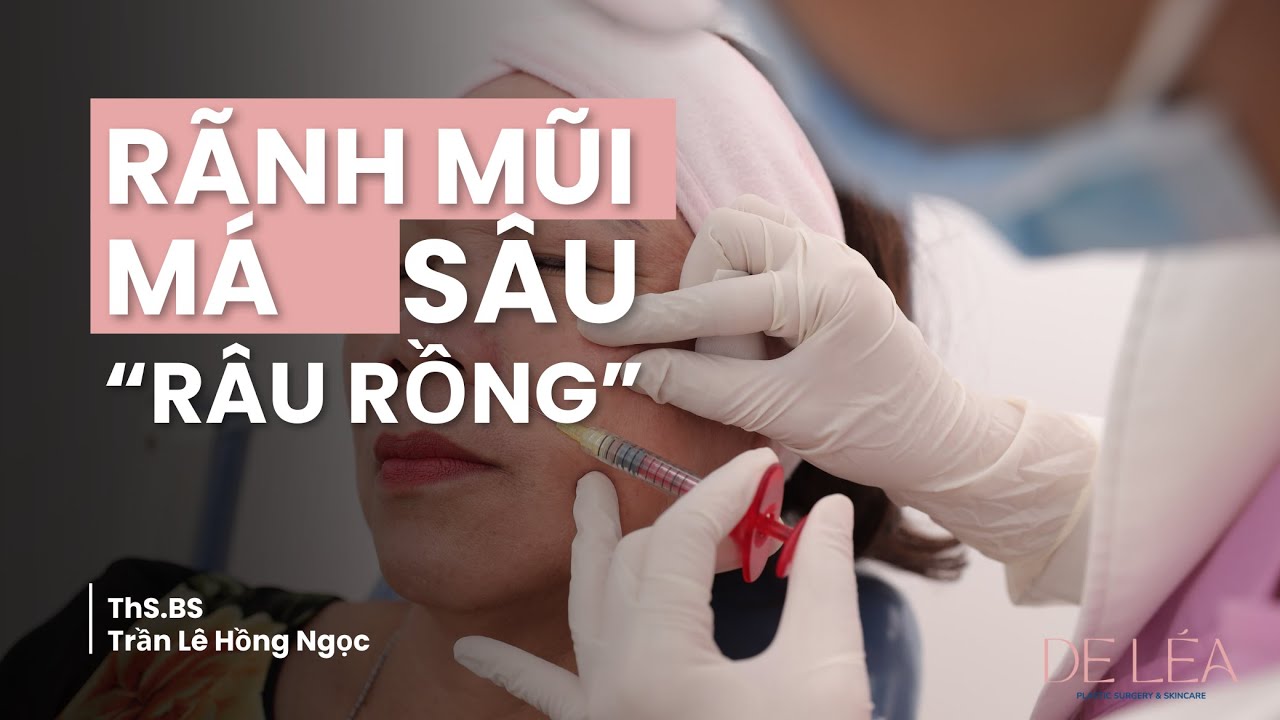 Rãnh mũi má sâu - Râu Rồng - Dr Ngọc - YouTube