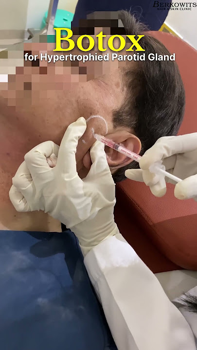 Botox for Hypertrophied Parotid Gland 🔥