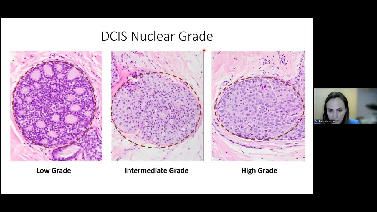 Dcis a pathologist s perspective 2023 ductal carcinoma in situ