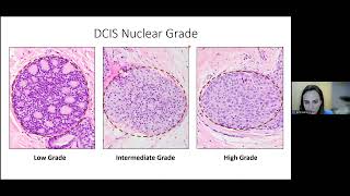 DCIS - A Pathologist's Perspective | 2023 Ductal Carcinoma In Situ Patient Forum