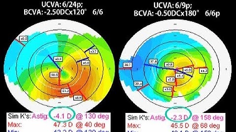CAIRS A new technique for Keratoconus and corneal ecstasias